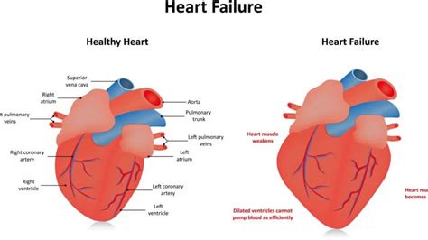 global hypokinesia of lv|left side heart failure symptoms.